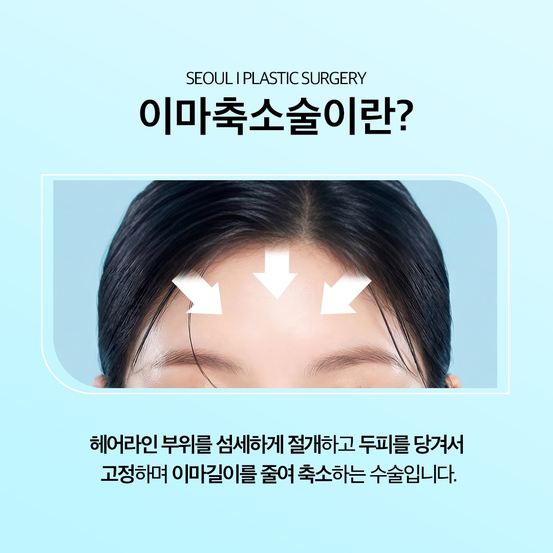 이마축소술 (2)