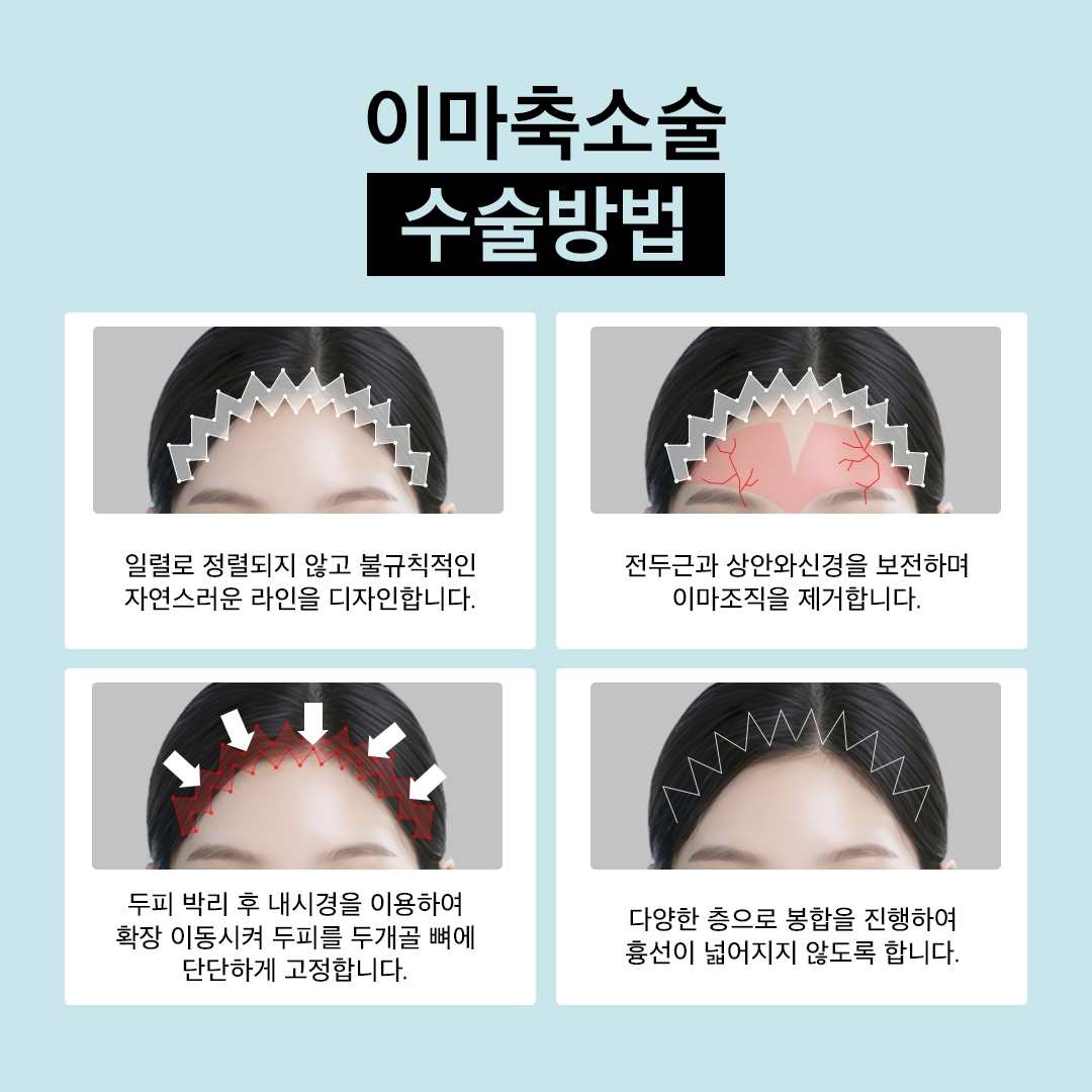 이마축소술 (5)