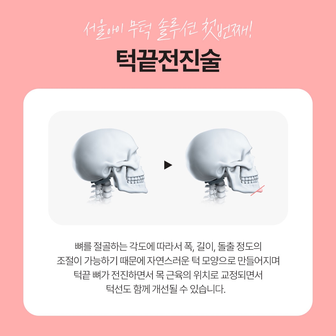 무턱성형 (5)