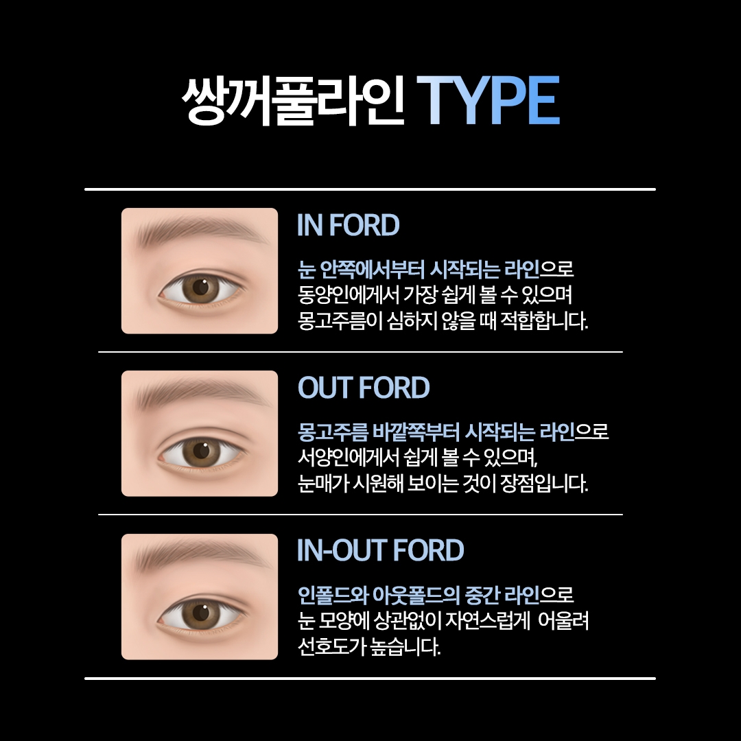 남자 눈매교정 (4)