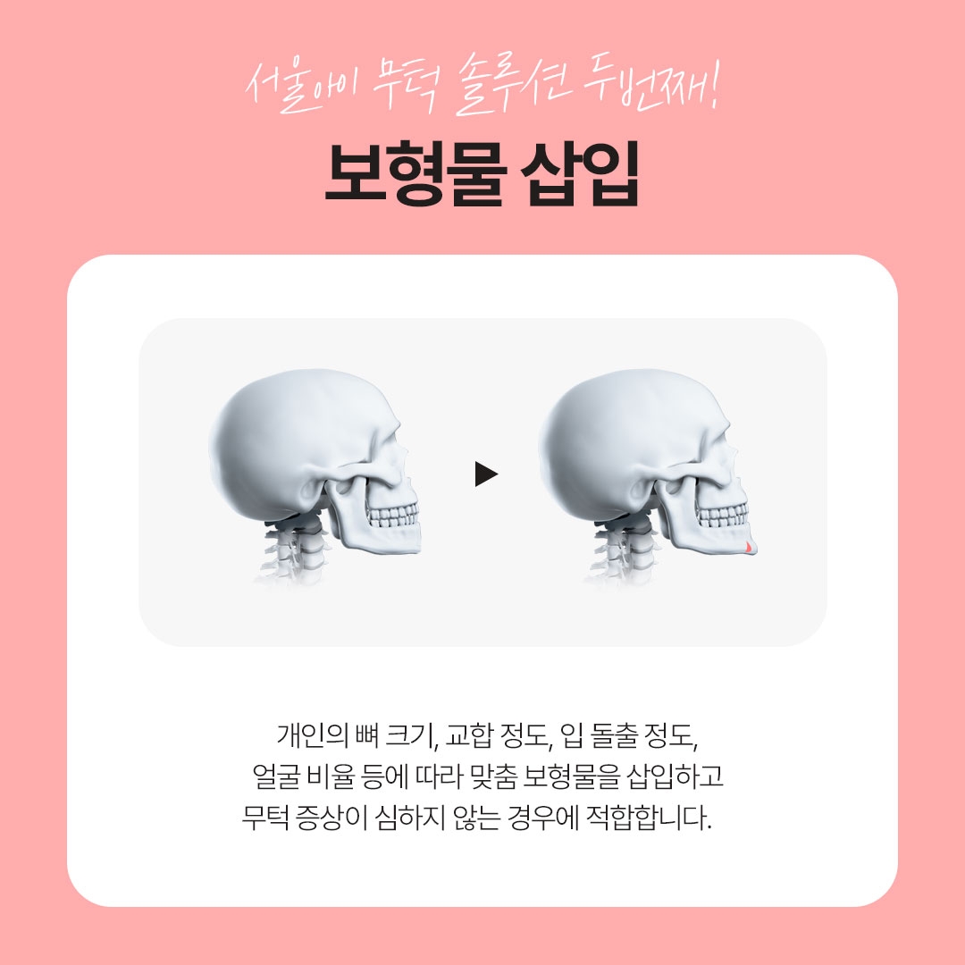 무턱성형 (6)